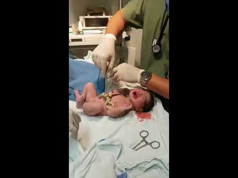 Video: 4 formas de cortar el cordón umbilical de un bebé