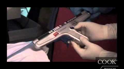 Dr. Alessandro Repici – Evolution® Esophageal Controlled-Release Stent - Partially Covered Placement