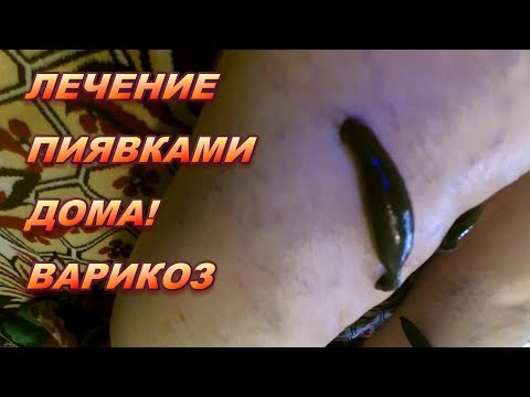 Лечение варикоза пиявками