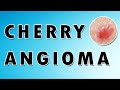 Cherry Hemangioma Symptoms, Treatment, and Causes