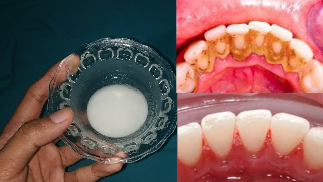 Karang gigi rontok dalam hitungan menit, Cara membersihkan karang gigi