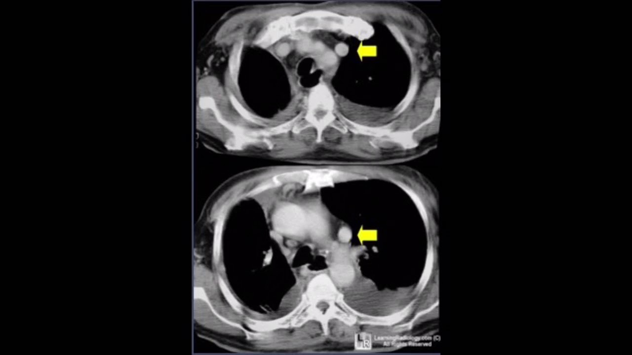 Persistent Left Superior Vena Cava - YouTube