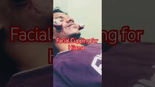 Facial Cupping Therapy Acne Pimples skin Treatment #skincare