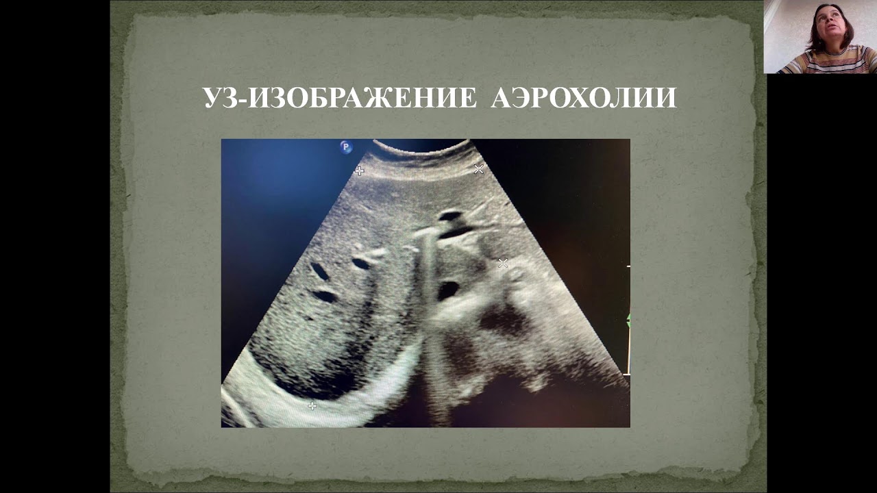 Бурцева Е.А. Ультразвуковая диагностика при очаговых заболеваниях печени. 14032024