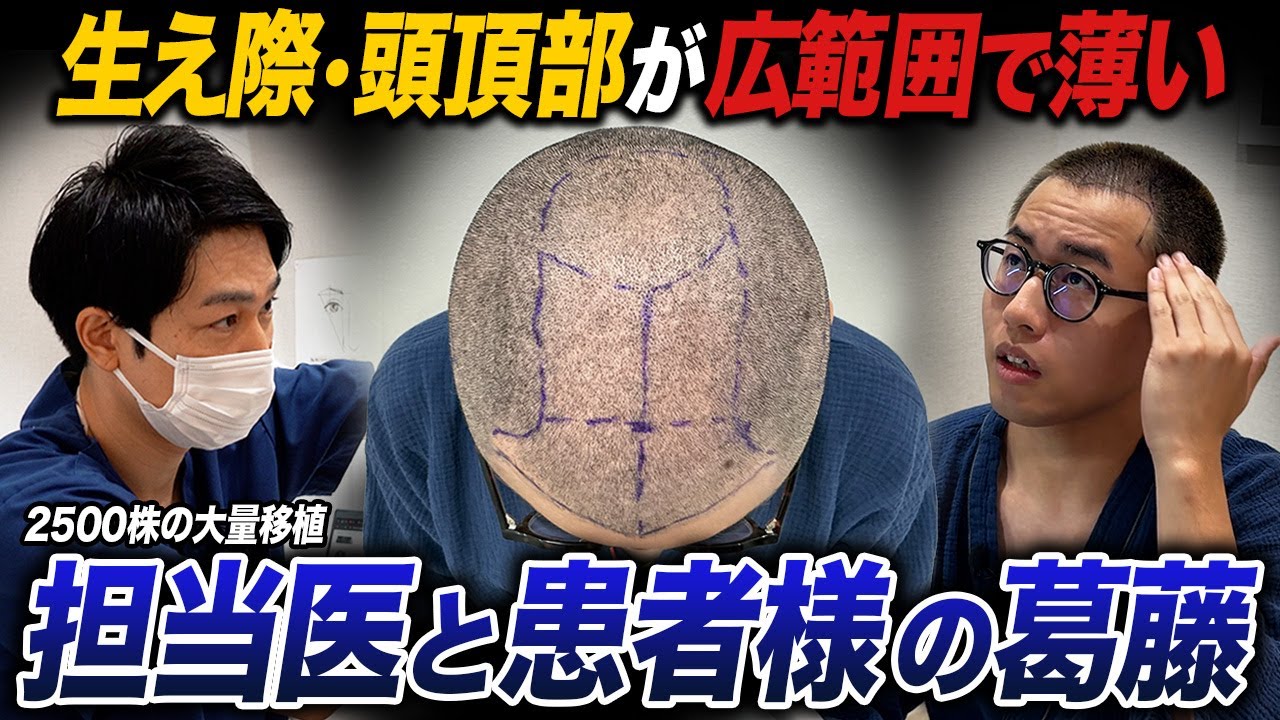 Which Is More Important for a Hair Transplant: The Hairline or the