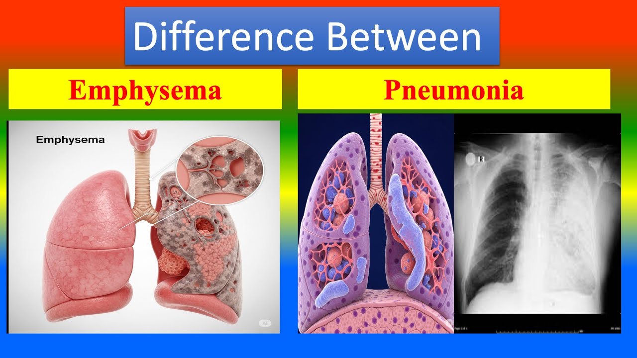 Difference between Emphysema and Pneumonia - YouTube