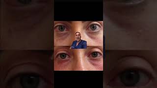 Fraxel Laser Resurfacing for Treatment of Syringomas