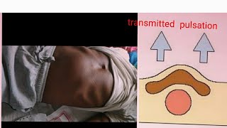 transmitted and expansile pulsation || Abdominal mass|| Transmitted pulstation|| expansile pulsation
