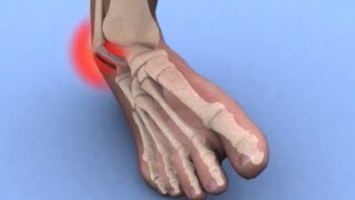 Urutan Seliuh Pergelangan Kaki Ankle Sprain Massage