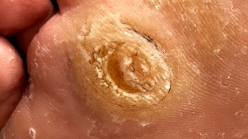 Huge Foot Calluses! Dig Out Hard Objects Foot Peg【Xue Yidao】