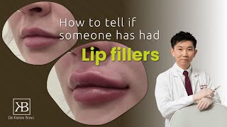 How to tell if someone has had lip filler injections?