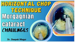 Horizontal Chop in a Hypermature Morgagnian Cataract: The Finer Nuances, Phacoemulsification