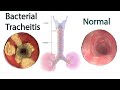 Bacterial Tracheitis - Symptoms, causes and treatment