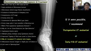 488. (For Physicians. Maisonneuve fx. 1:10~16) Diagnosis & Tx. Maisonneuve fracture: Diagnosis an...