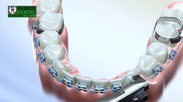 Cận cảnh quy trình tháo niềng răng