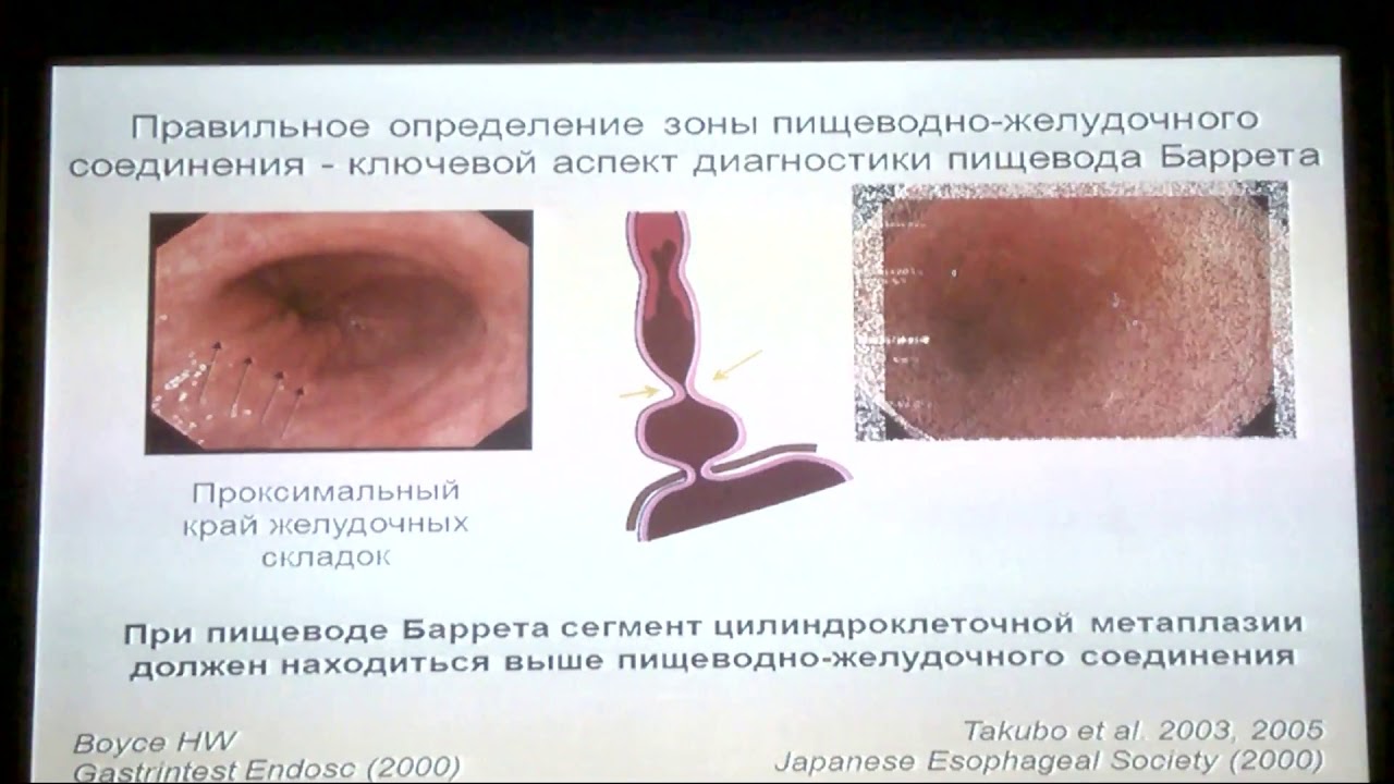 17 Кашин СВ Пищевод Барретта Диагностика и лечение Взгляд Эндоскописта ...