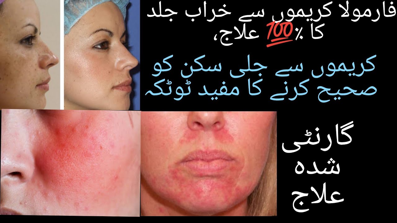 face Redness treatment at home/ formula cream side effects. YouTube