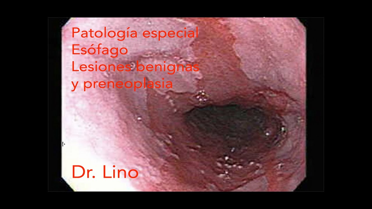 Patología del Tubo digestivo - Esófago Tumores benignos y preneoplasia.