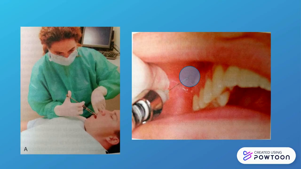 Bloqueo del Nervio Alveolar Superior Posterior - YouTube