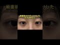 さえら先生の涙袋ヒアル!整形感なくナチュラルな仕上がりが得意です⟡.&middot;*.