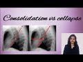 Chest X ray | How to differentiate consolidation from  collapse |