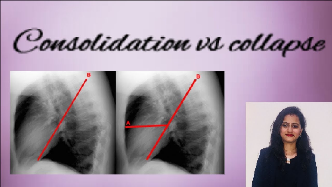 Chest X Ray How To Differentiate Consolidation From Collapse YouTube Chest X Ray How To Differentiate Consolidation From Collapse YouTube