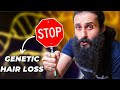 Stop blaming your genetics for hair loss  fix this instead  bearded chokra