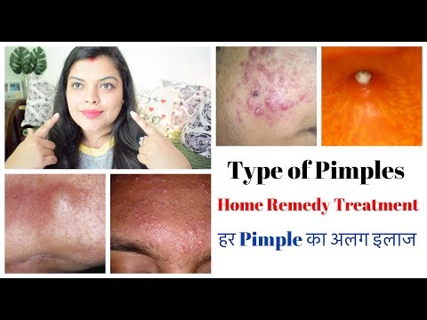 Types of Pimple & Home Remedy - Pimple Scars Treatment - 동영상