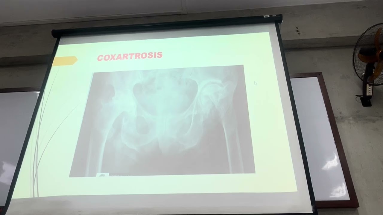 21. Afecciones degenerativas articulares - TRAUMATOLOGÍA