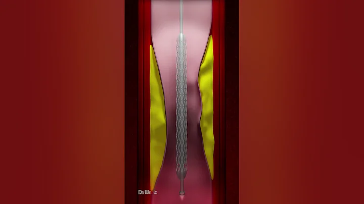 Coronary Artery Stent Placement (Animation)