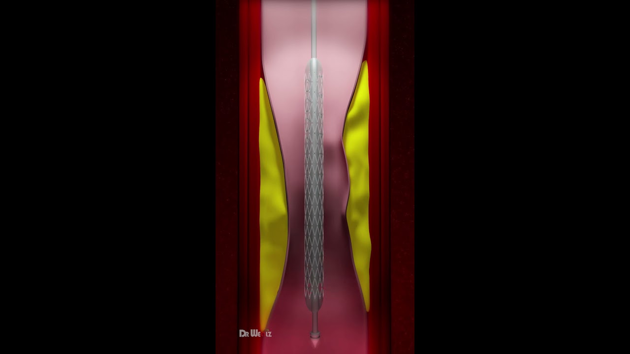 Coronary Artery Stent Placement Animation 
