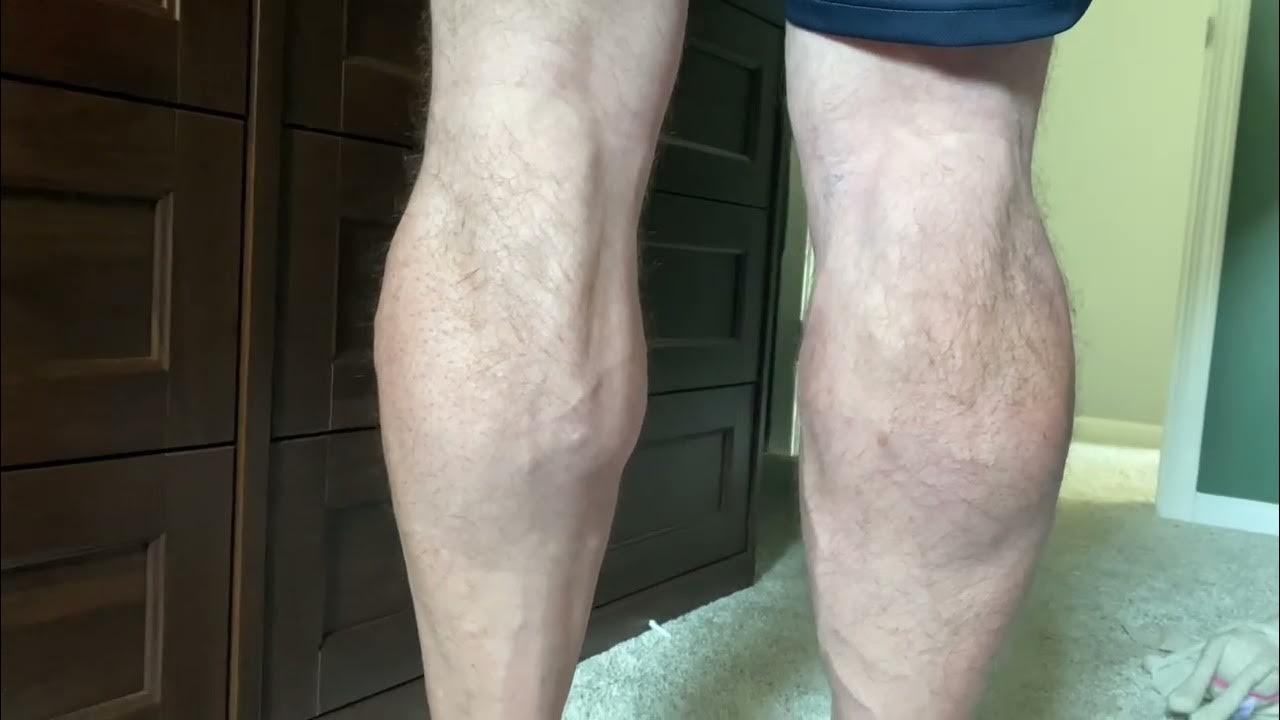 Medial calf (inner) head deformity no tear symptoms experienced YouTube