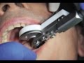 Атравматичное удаление переднего зуба системой Benex Control