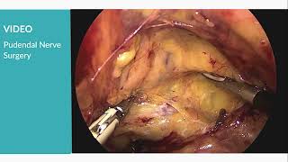 Pudendal Neuralgia Elmcherqui
