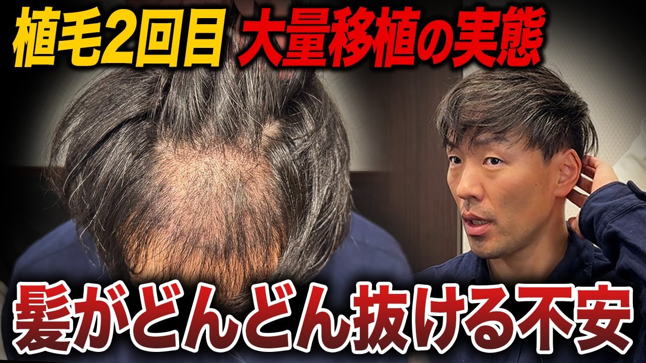 【2回目植毛1ヶ月】1回目より不安が大きい…抜け毛が止まらないリアルな現実