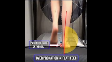 How Overpronation Weakens the Arch and Causes Flat Feet