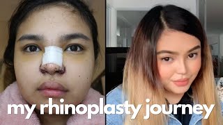 Rhinoplasty PostOp Nightmare. (My Rhinoplasty Journey)