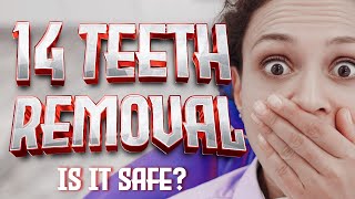14 Teeth Removal: Is It Safe? 🤔🪥