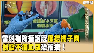 雷射剜除攝護腺！不痛血尿小心罹癌風險！【聚焦2.0】第530集