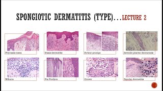 5- Spongiotic Dermatitis (2)
