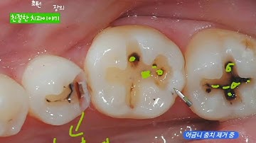 충치치료 어금니 충치치료과정 및 치료법  [레진 인레이 때우기]