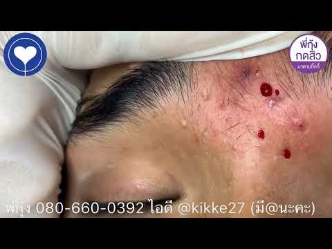 Remover of Blackheads & Whiteheads Easy-CYSTIC ACNE ON FACE # Millia