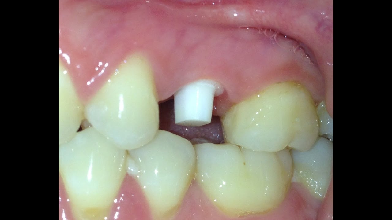 Zirconia ceramic implants NYC by Veselin Shumantov DDS (646) 8948441