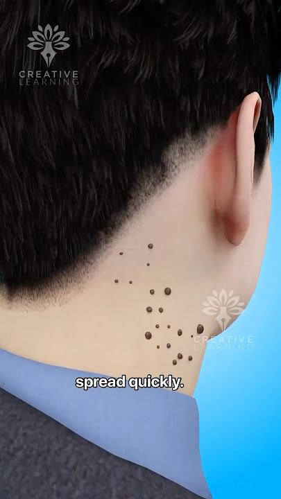 Warts Explained: How They Form and Types You Should Know #shorts #warts #skintags - Creativelearning