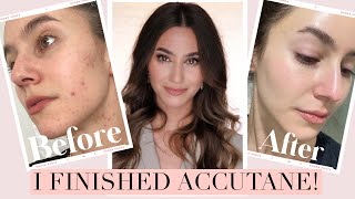 I FINISHED ACCUTANE! 🎉 Results + Side Effects, Low Dose Isotretinoin Journey | Karima McKimmie