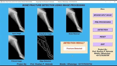 Bone Fracture Detection Using Image Processing | With Source Code | Matlab Project Fracture Detect