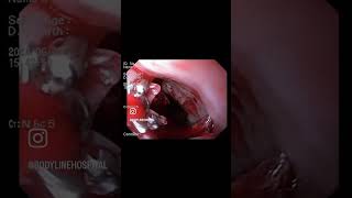 Esophageal cancer on upper GI endoscopy #endoscopy #esophagealcancer #biopsy