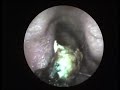 Wax Removal by Wax hook.wmv