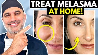 What you NEED to know about treating Melasma AT HOME the RIGHT way!
