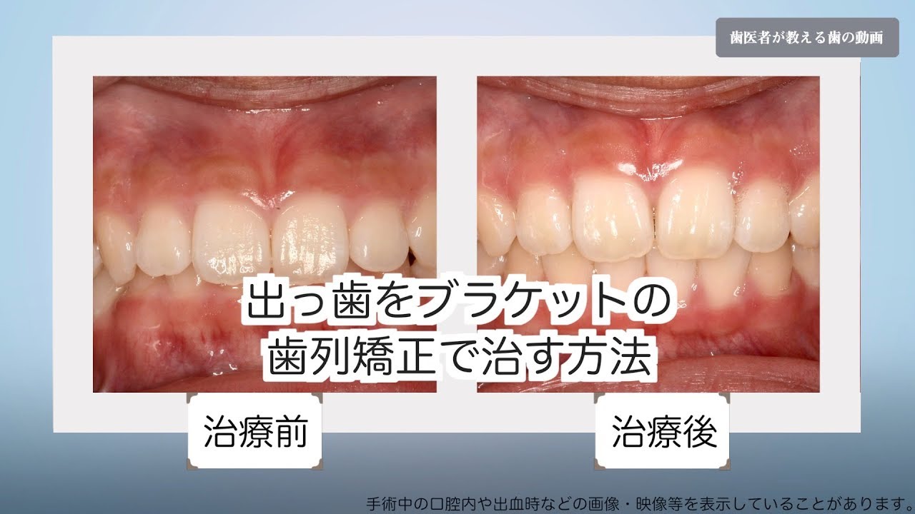 出っ歯の治し方 確実に治る歯列矯正の流れ Youtube